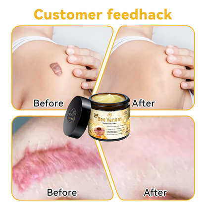 Oveallgo™ Bee Venom Skin Treatment Cream（𝐴𝐴𝐷 𝑅𝑒𝑐𝑜𝑚𝑚𝑒𝑛𝑑𝑒𝑑）