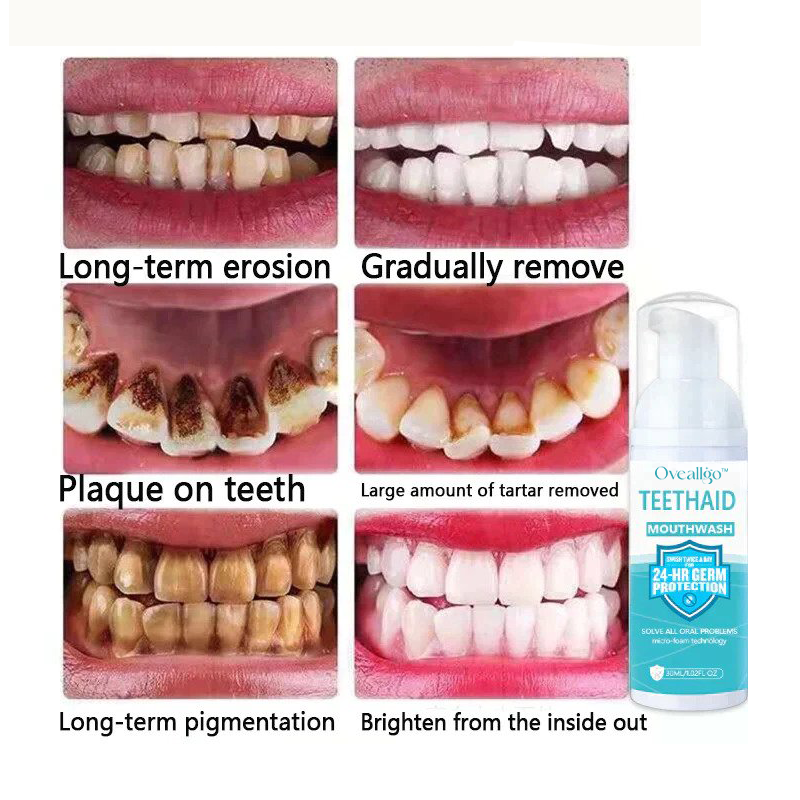 ✨Dentist-Recommended 🦷 Oveallgo™ Intensive Stain Removal Oral Cleansing Mousse